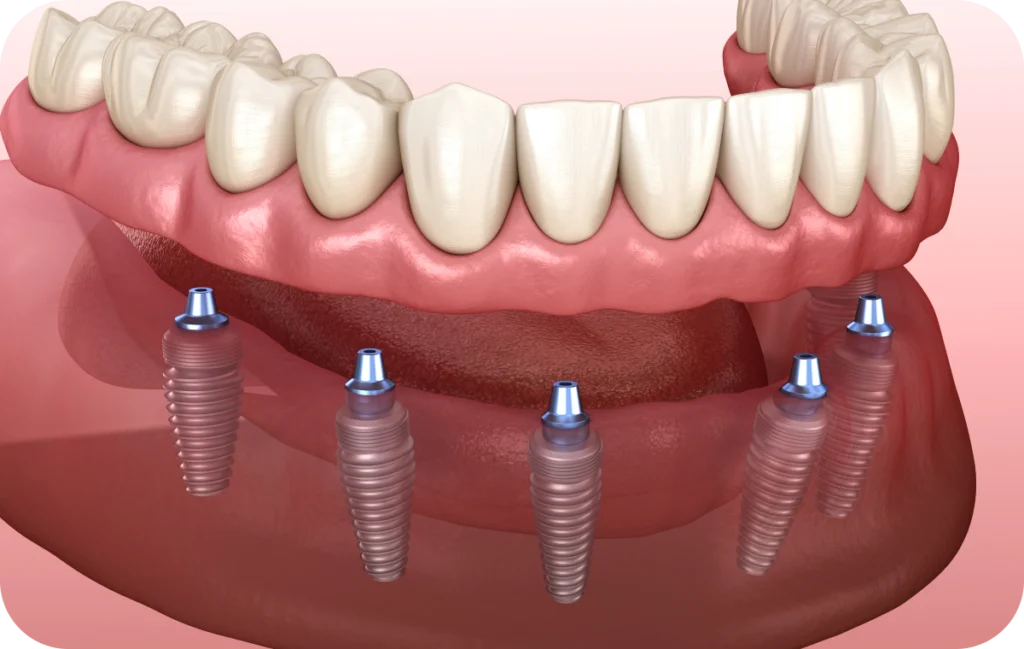all on fixation immediate villeneuve d ascq All on 4 / All on 6 Chirurgiens-dentistes | Villeneuve d’Ascq près de Lille