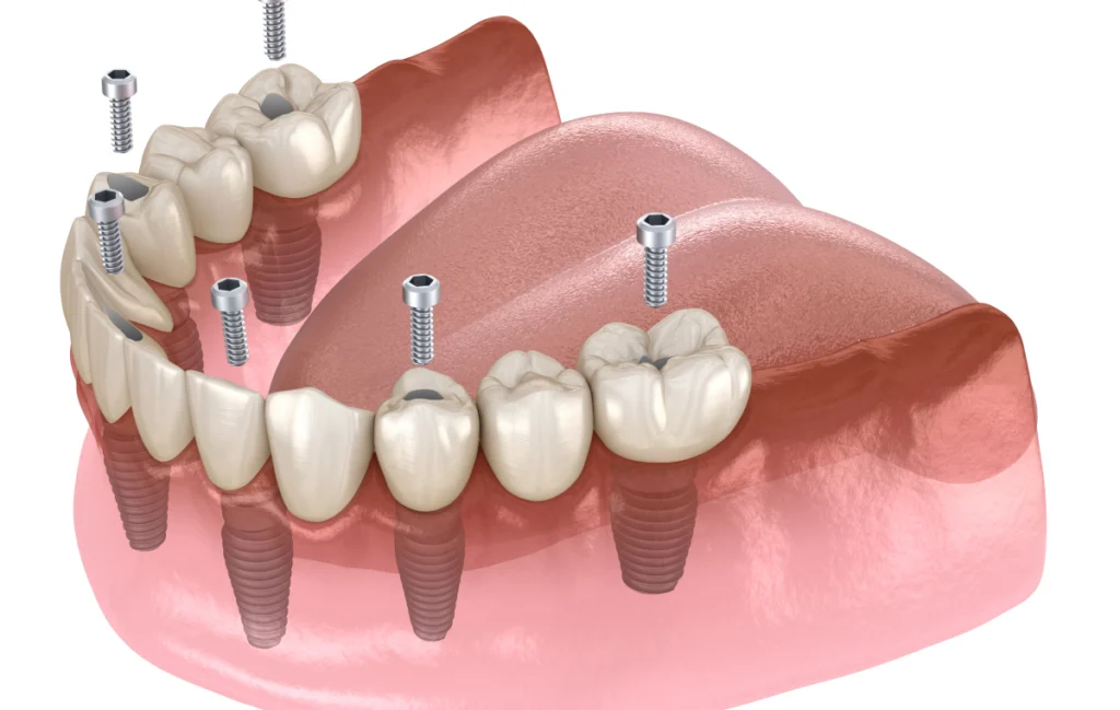 all on stabilite prothese villeneuve d ascq All on 4 / All on 6 Chirurgiens-dentistes | Villeneuve d’Ascq près de Lille