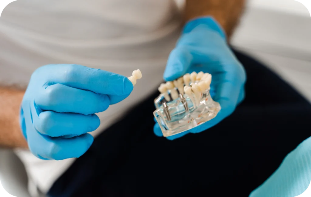 bridge implant dentaire villeneuve d ascq Implant dentaire Chirurgiens-dentistes | Villeneuve d’Ascq près de Lille