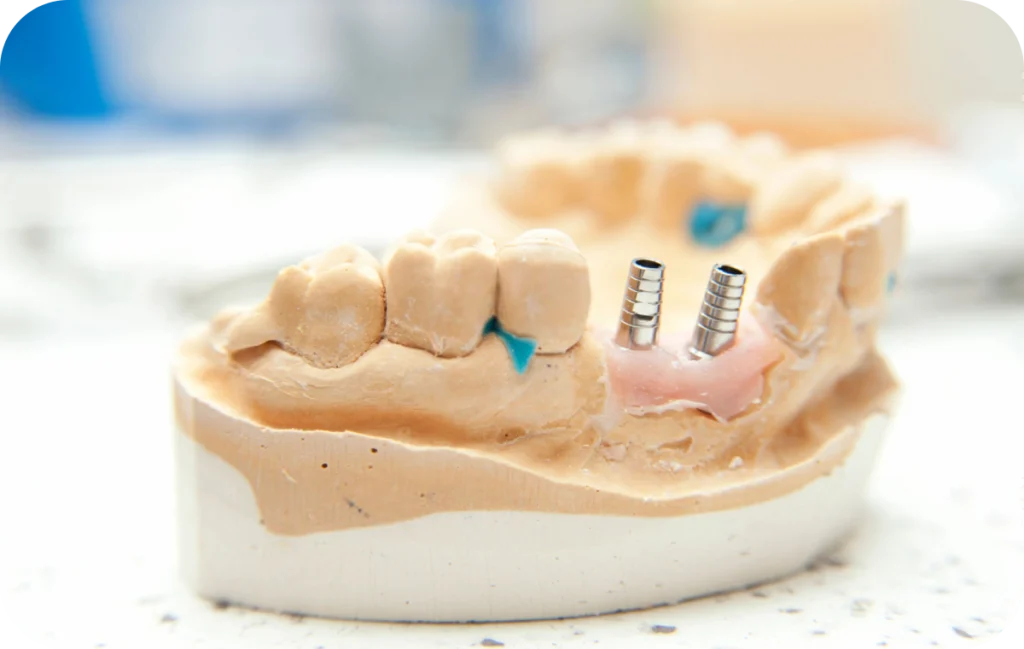 greffe osseuse cicatrisation osseuse villeneuve d ascq Greffe osseuse Chirurgiens-dentistes | Villeneuve d’Ascq près de Lille