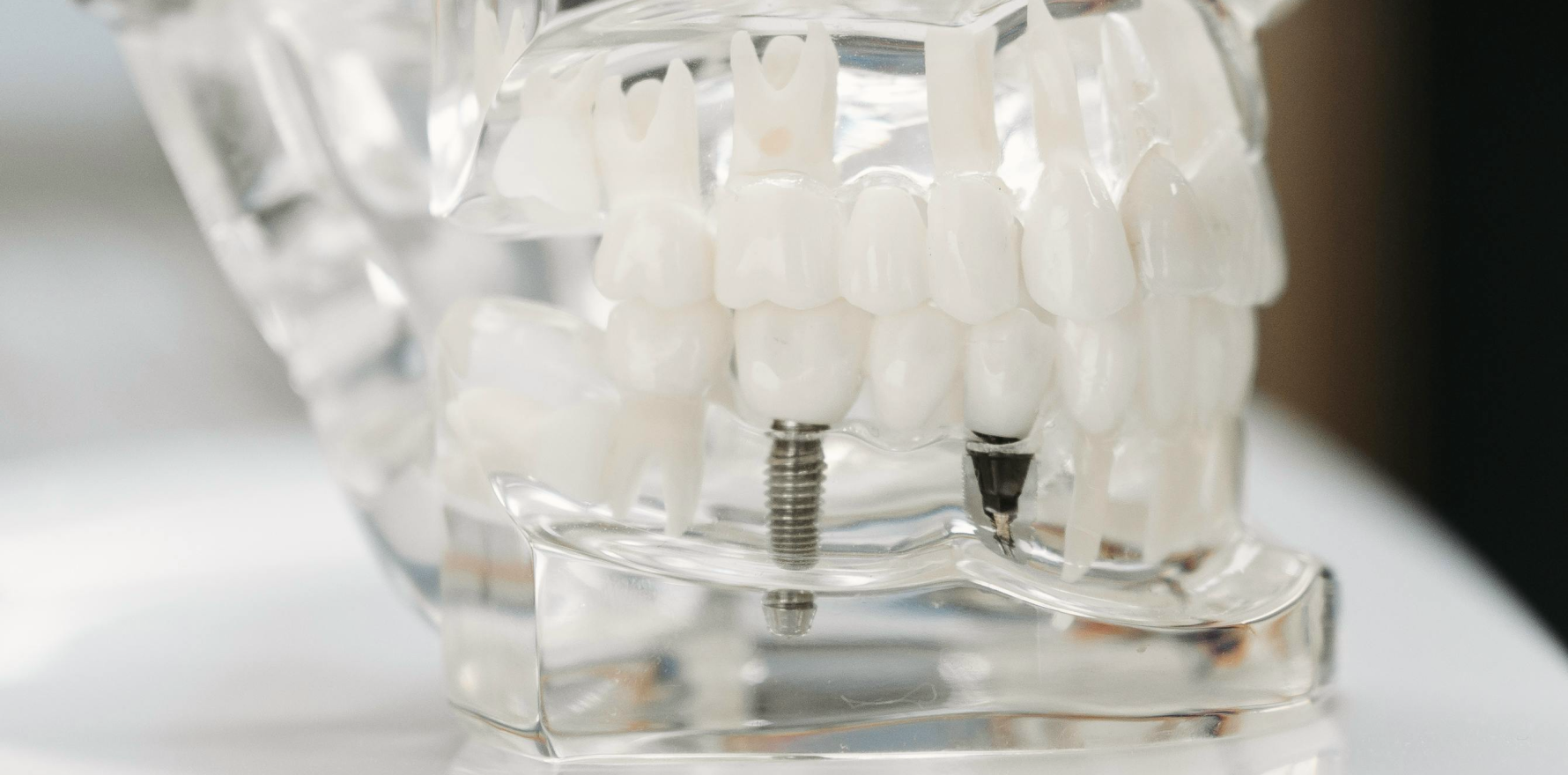 implants dentaires prevention resorption villeneuve d ascq Implant dentaire Chirurgiens-dentistes | Villeneuve d’Ascq près de Lille