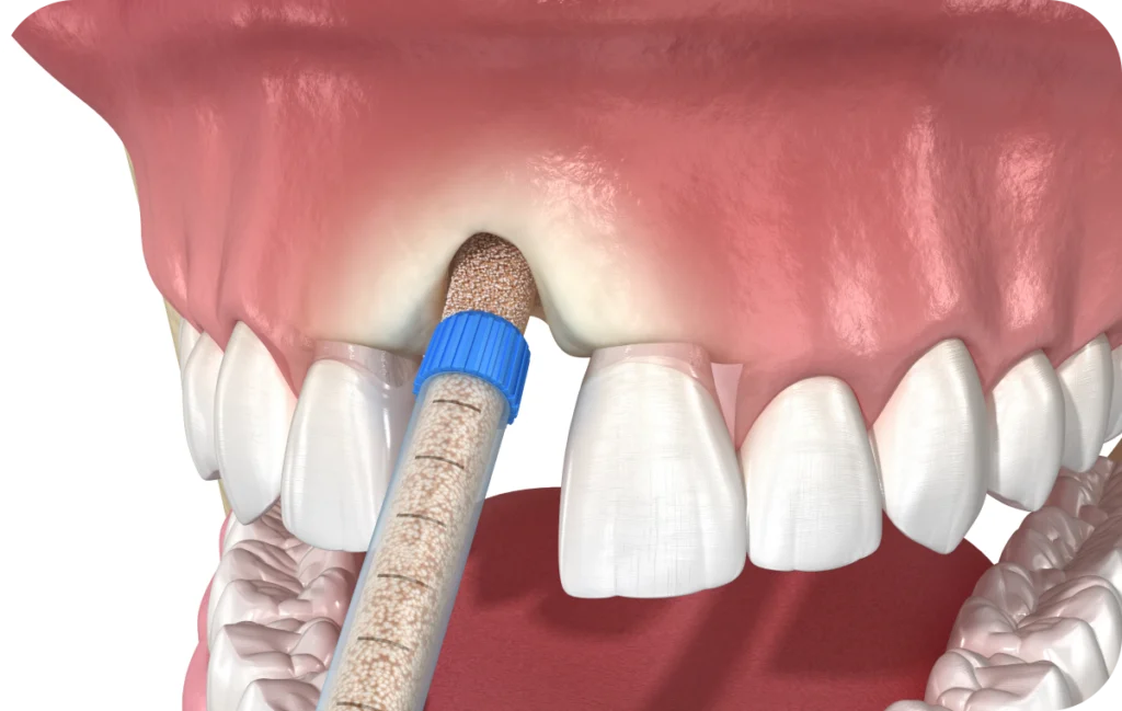 prise charge dentaire complete villeneuve d ascq Préservation alvéolaire Chirurgiens-dentistes | Villeneuve d’Ascq près de Lille