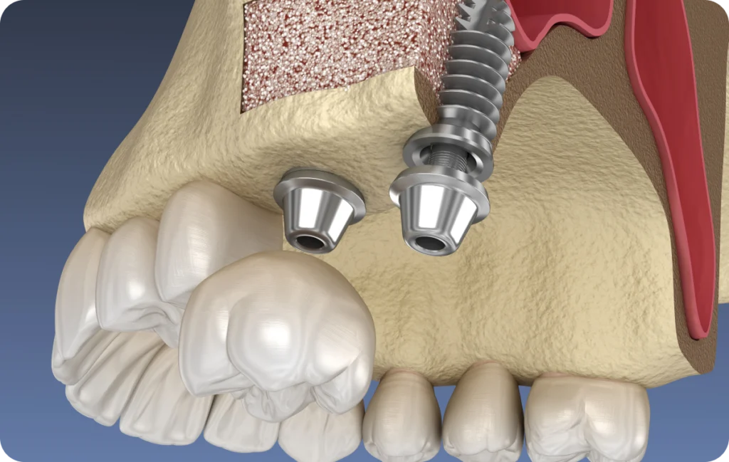 sinus lift comblement osseux villeneuve d ascq Sinus lift Chirurgiens-dentistes | Villeneuve d’Ascq près de Lille