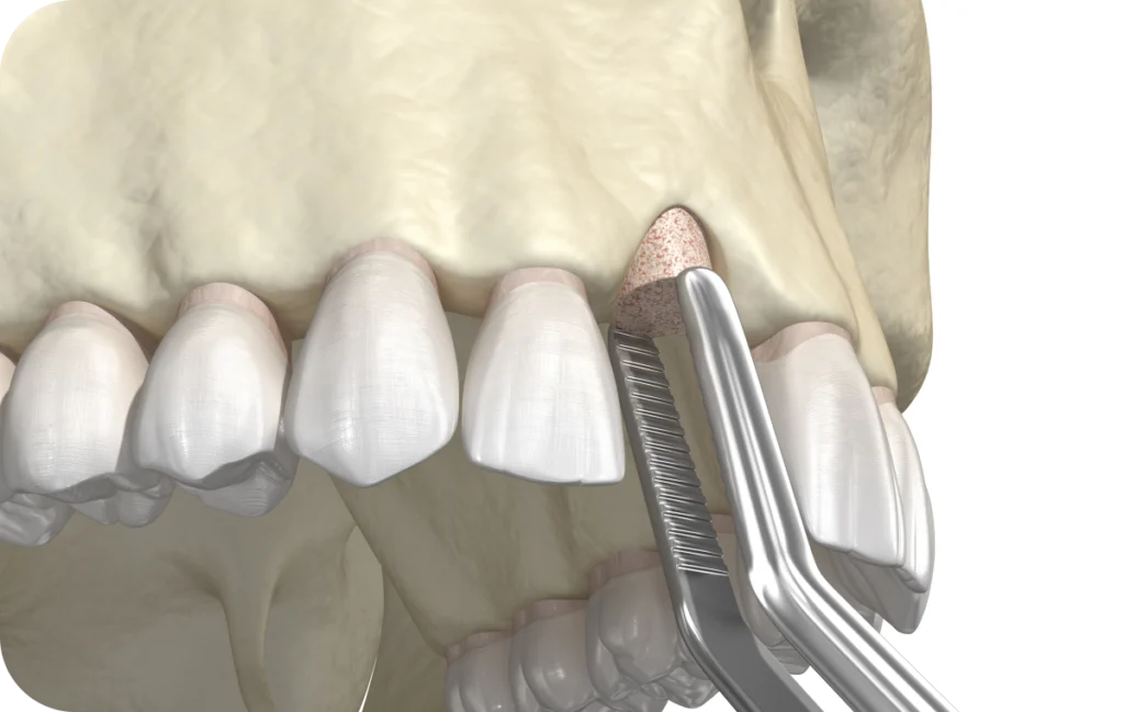 sinus lift dentaire villeneuve d ascq Greffe osseuse Chirurgiens-dentistes | Villeneuve d’Ascq près de Lille