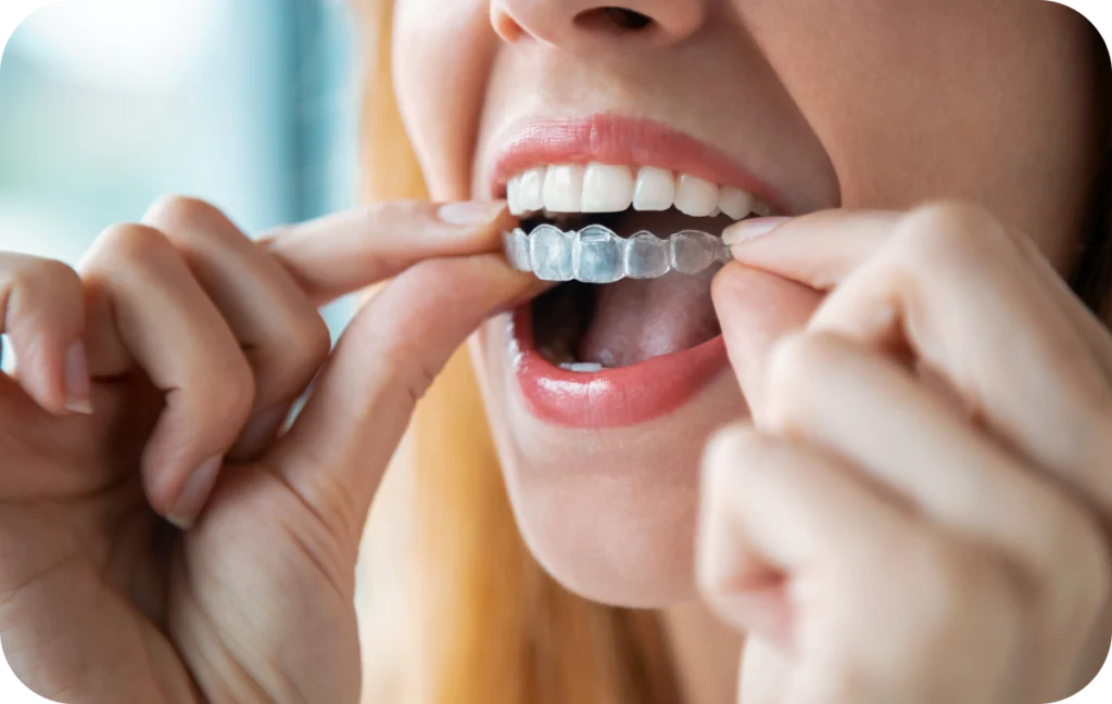 aligneurs invisibles discret alignement villeneuve d ascq Conseils sur orthodontie invisible Chirurgiens-dentistes | Villeneuve d’Ascq près de Lille