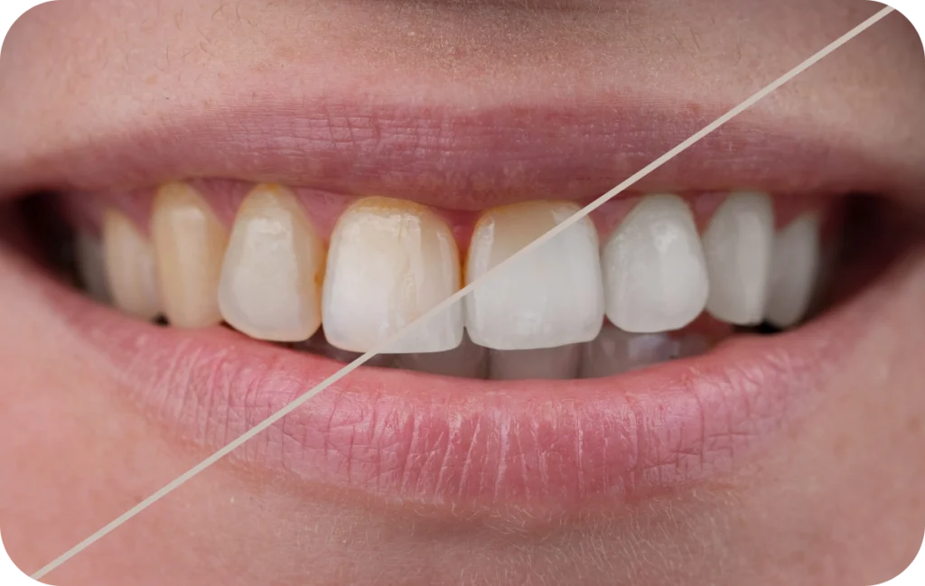 eclaircissement dentaire sourire eclatant villeneuve d ascq Esthétique Chirurgiens-dentistes | Villeneuve d’Ascq près de Lille