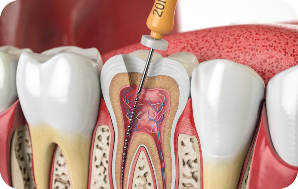 endodontie soin pulpaire villeneuve d ascq Endodontie Chirurgiens-dentistes | Villeneuve d’Ascq près de Lille