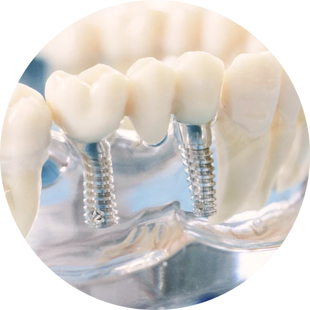 Implants dentaires : les bonnes pratiques