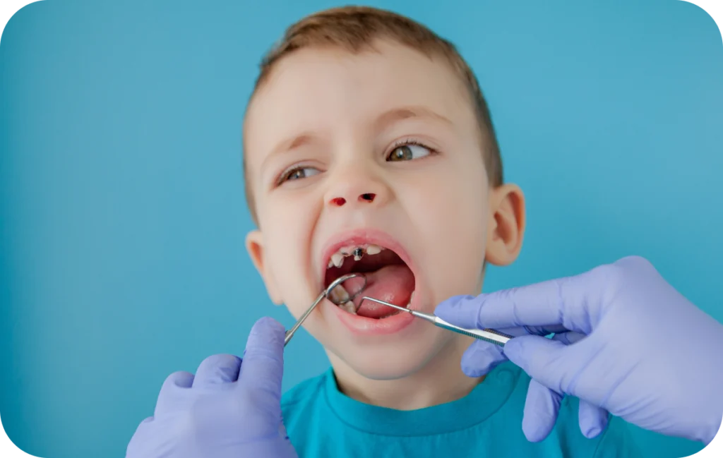 pedodontie prevention caries infantiles villeneuve d ascq Pédodontie Chirurgiens-dentistes | Villeneuve d’Ascq près de Lille