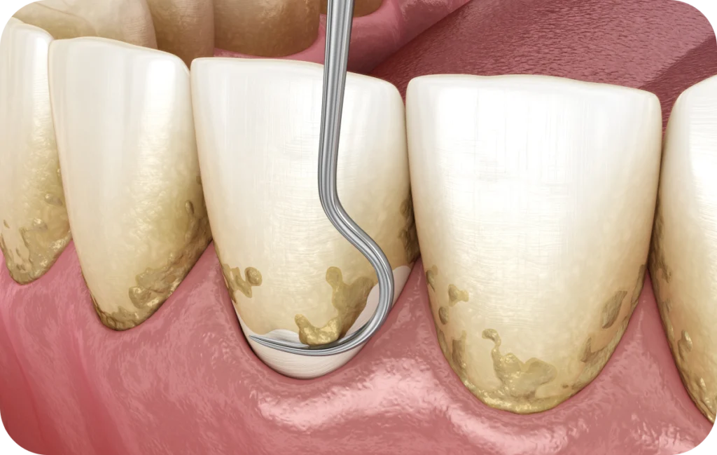 soins gencives suivi parodontal villeneuve d ascq Soins des gencives  Chirurgiens-dentistes | Villeneuve d’Ascq près de Lille